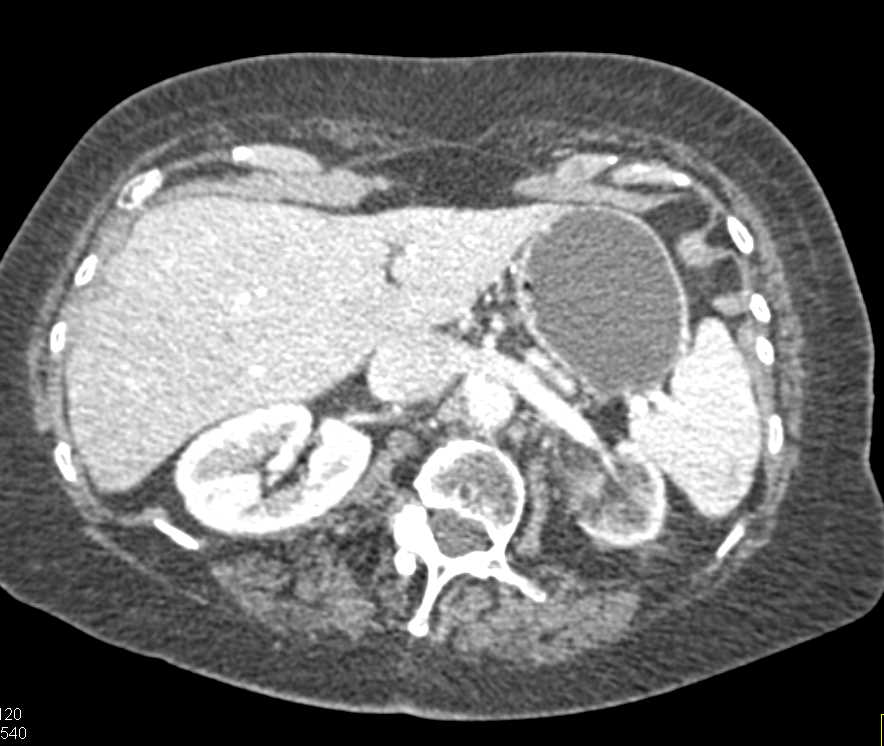 Transitional Cell Carcinoma Left Renal Pelvis - CTisus CT Scan