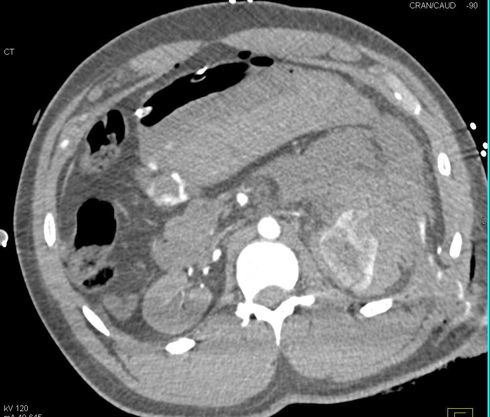 Multiorgan Trauma with Active Bleed in Abdomen on CTA as Well as the Left Kidney - CTisus CT Scan