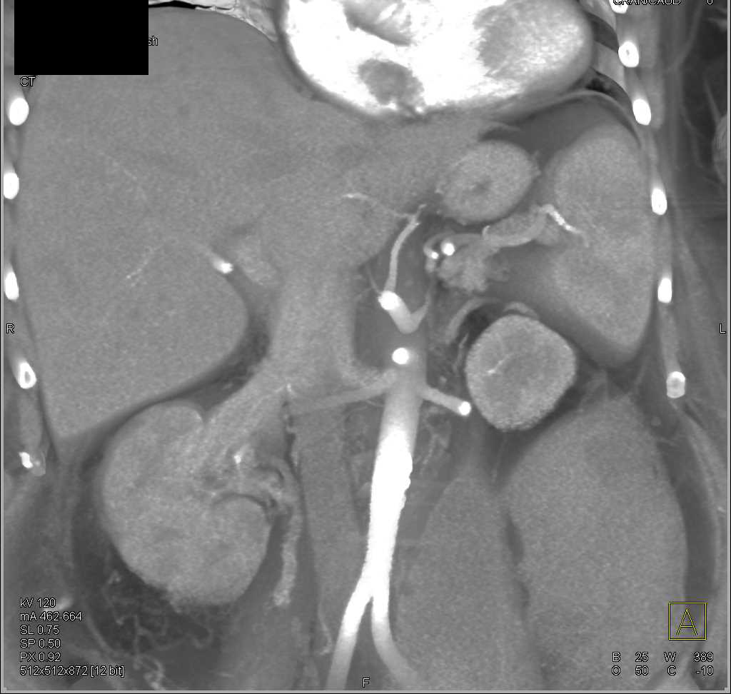 Infiltrating Right Renal Cell Carcinoma Invades the Right Renal Vein and Inferior Vena Cava (IVC) - CTisus CT Scan