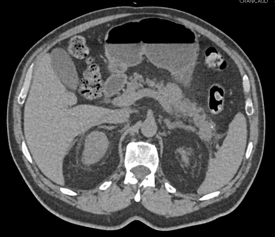 Incidental Renal Cell Carcinoma Upper Pole Right Kidney - CTisus CT Scan