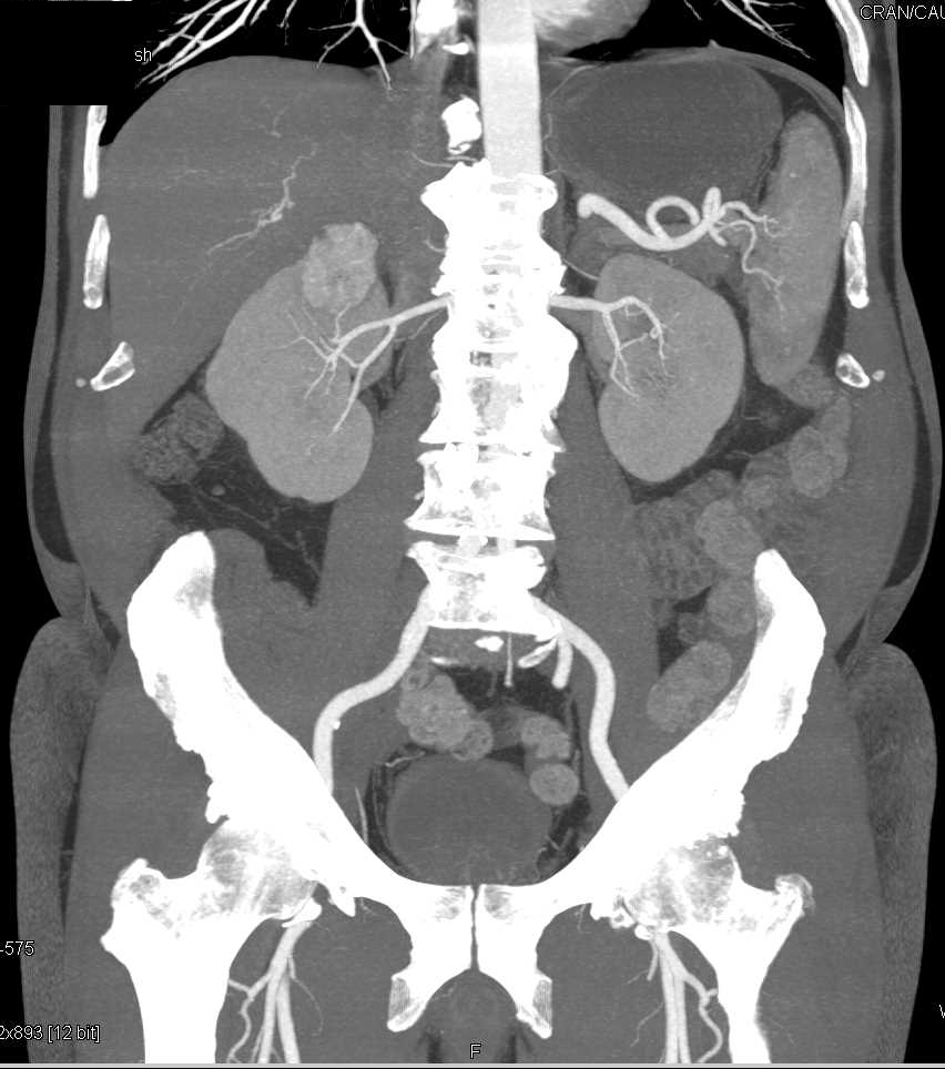 Incidental Renal Cell Carcinoma Upper Pole Right Kidney - CTisus CT Scan