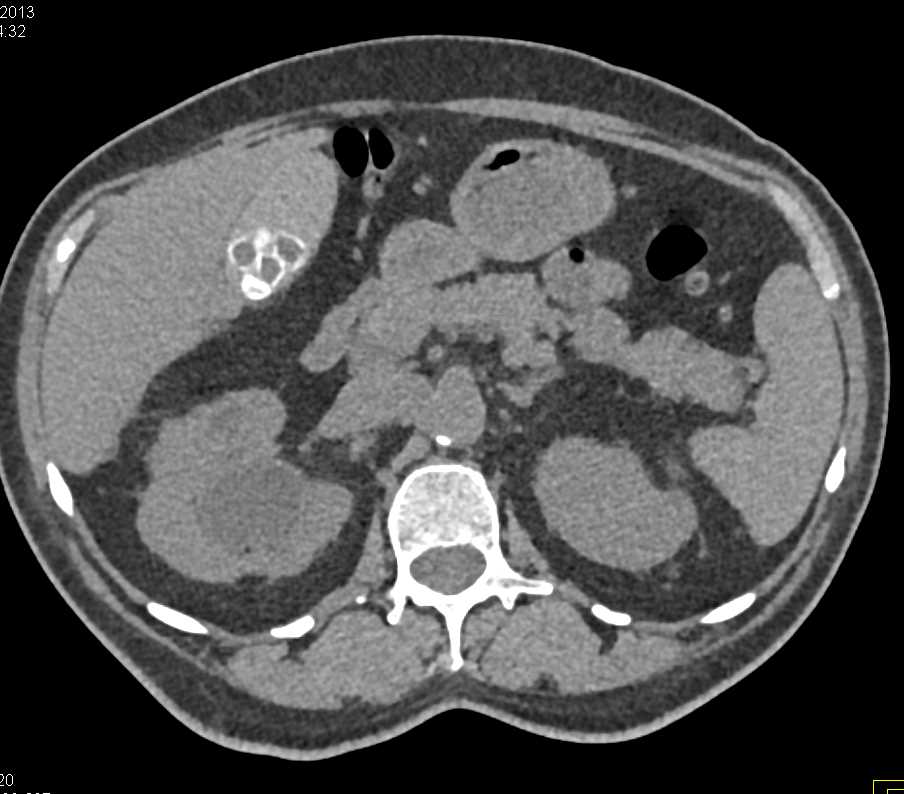 Transitional Cell Carcinoma of the Right Renal Pelvis - CTisus CT Scan