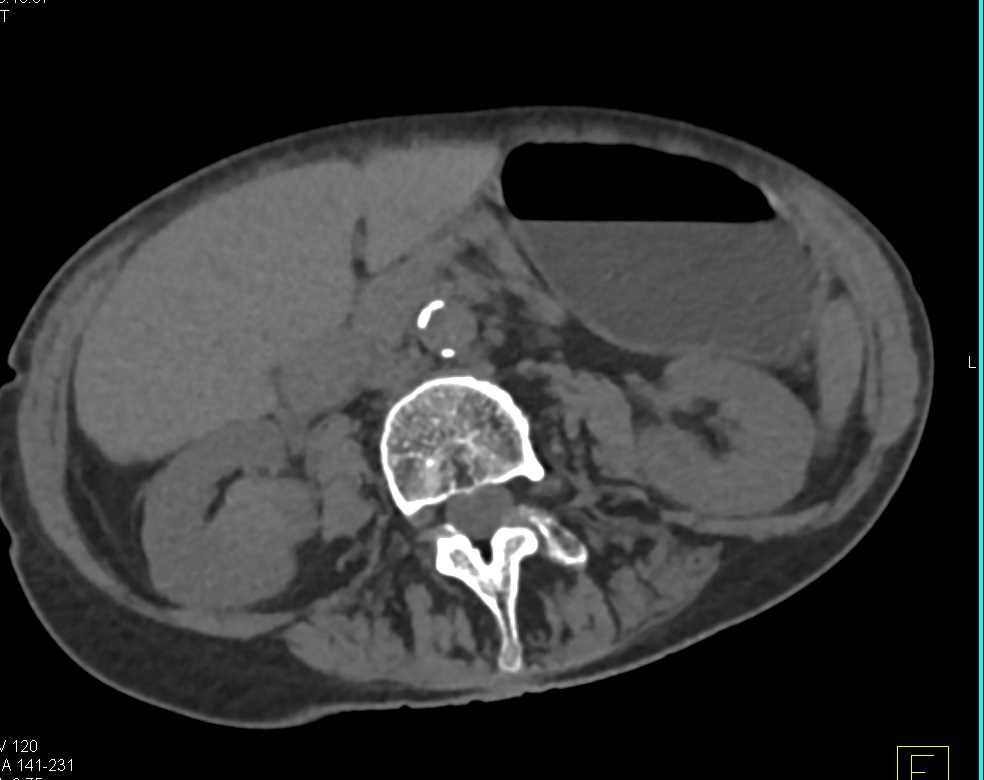 Papillary Right Renal Cell Carcinoma - CTisus CT Scan