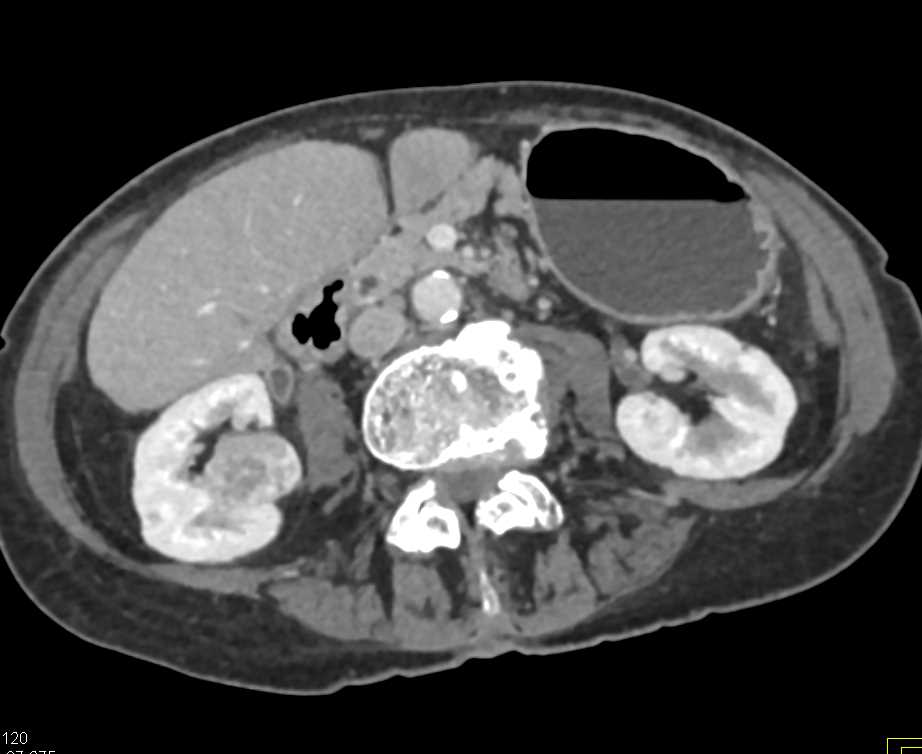 Papillary Right Renal Cell Carcinoma - CTisus CT Scan