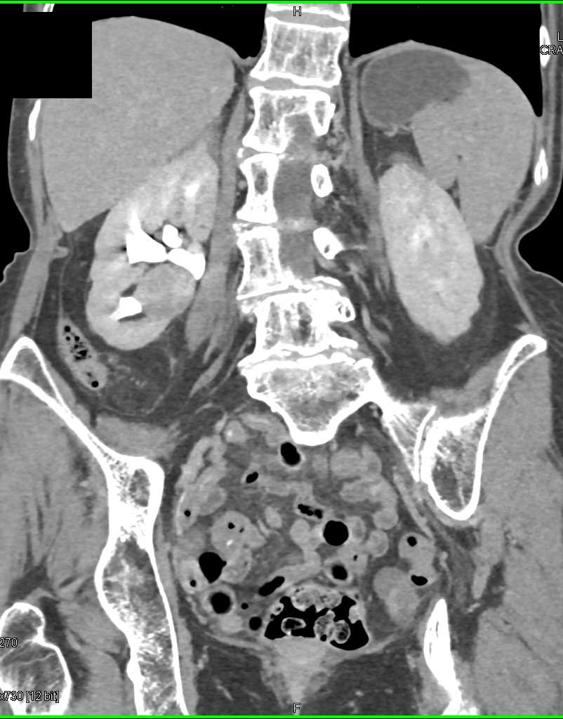 Papillary Right Renal Cell Carcinoma - CTisus CT Scan