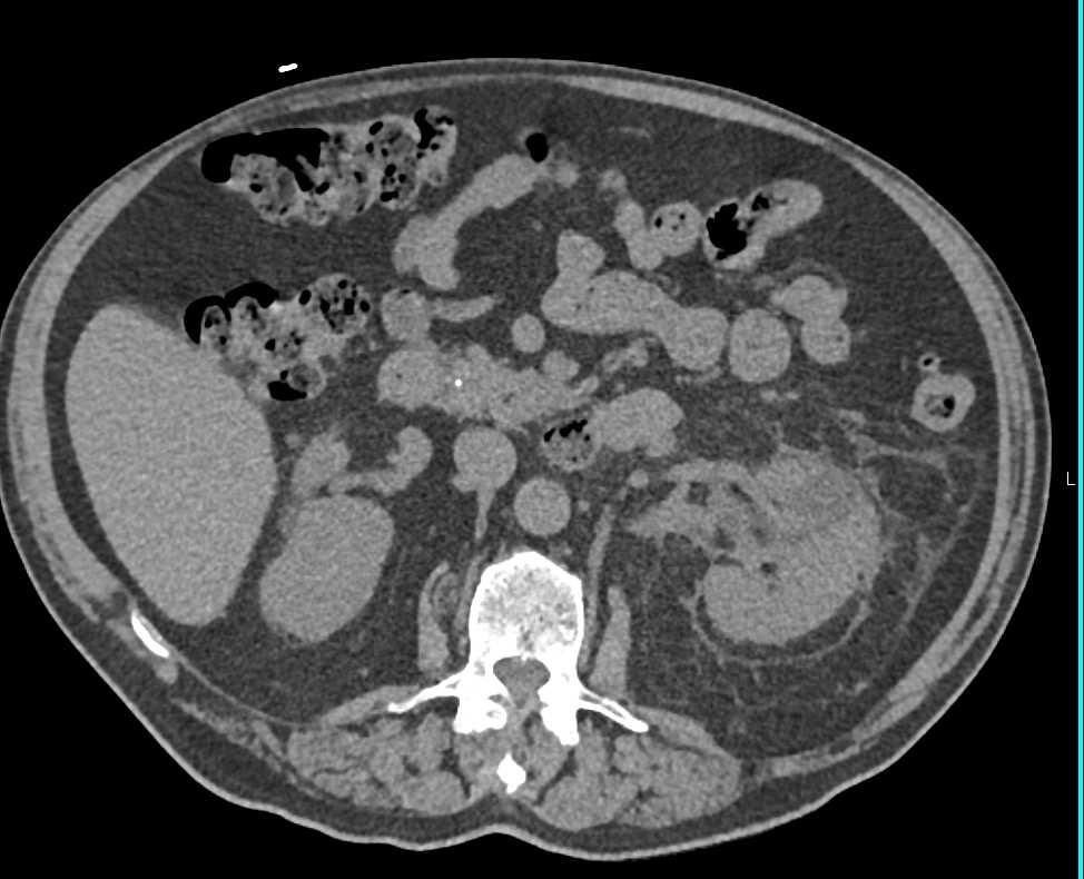 Acute Pyelonephritis - CTisus CT Scan