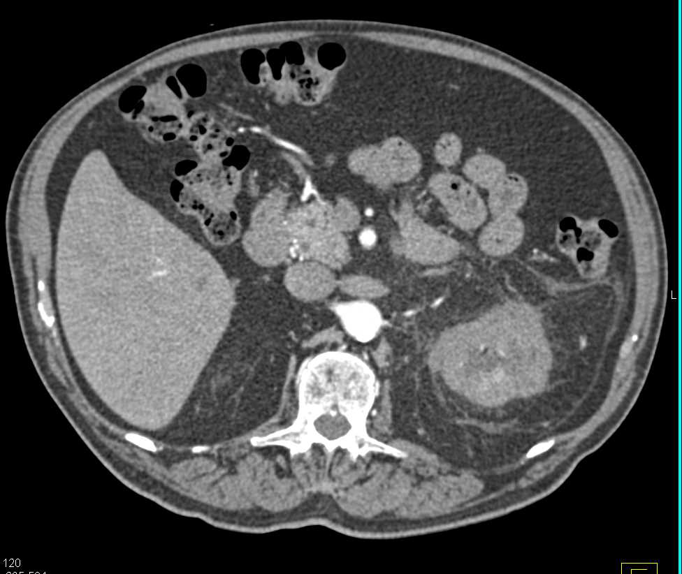 Acute Pyelonephritis - Kidney Case Studies - CTisus CT Scanning