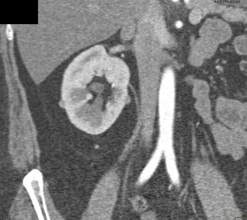 Several Under 1cm Right Renal Cell Carcinomas - CTisus CT Scan