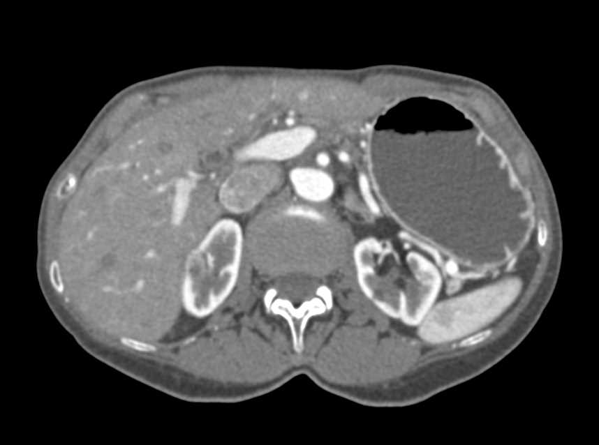 1 cm Renal Cell Carcinoma Right Kidney - CTisus CT Scan