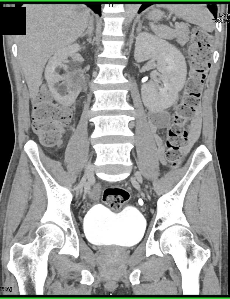 Transitional Cell Carcinoma of the Right Renal Pelvis - CTisus CT Scan