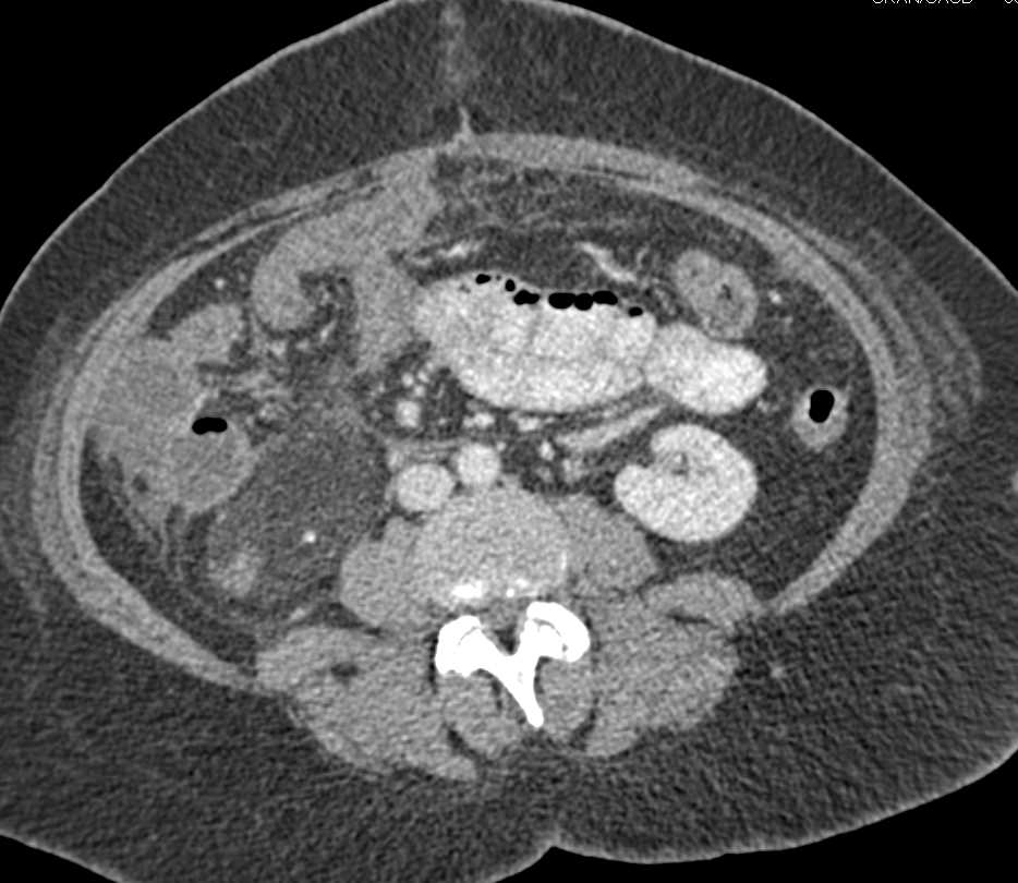 Renal Angiomyolipoma - CTisus CT Scan