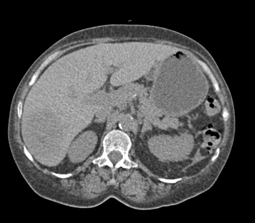 Renal Lymphoma with Liver Metastases - CTisus CT Scan