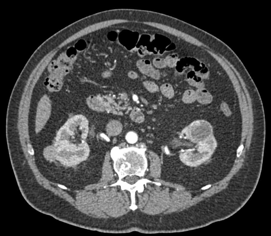 Bilateral Renal Cell Carcinomas - CTisus CT Scan