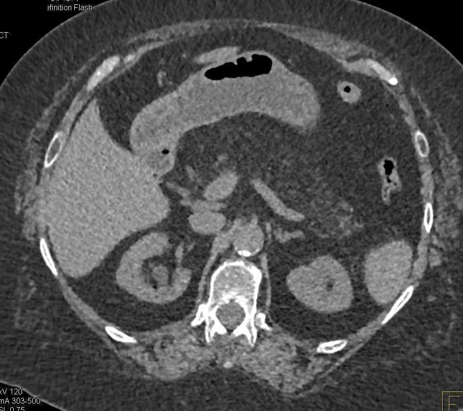 2 cm Right Renal Adenocarcinoma - CTisus CT Scan