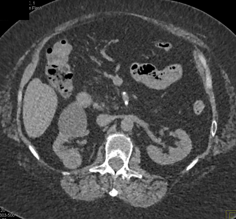 Subtle Right Renal Cell Carcinoma - CTisus CT Scan