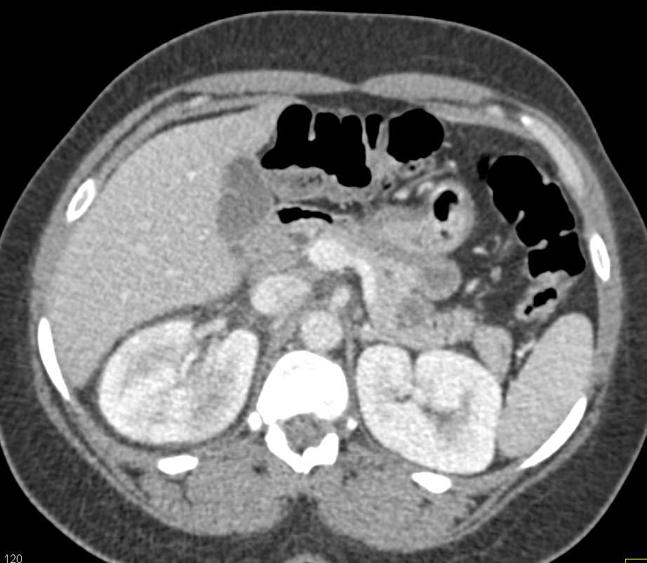 Acute Pyelonephritis Right Kidney - CTisus CT Scan