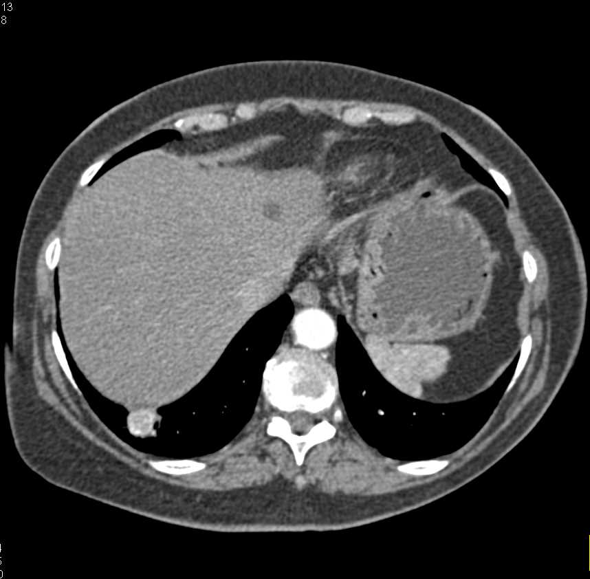 Right Renal Cell Carcinoma Invades the Renal Vein and Inferior Vena Cava (IVC) - CTisus CT Scan