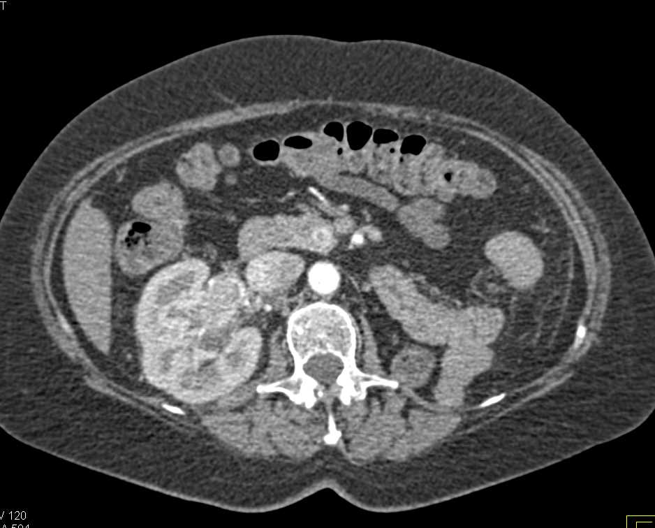 Renal Cell Carcinoma in Contralateral Kidney with Arteriovenous (AV) Shunting and Renal Vein Involvement - CTisus CT Scan