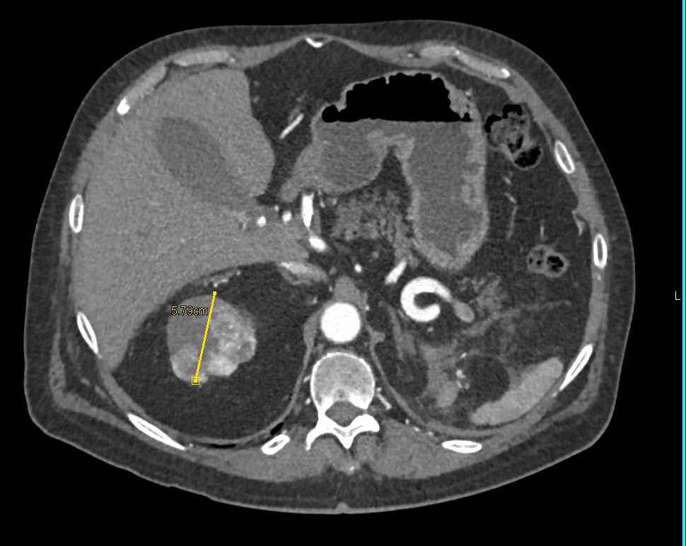 Renal Cell Carcinoma with Arteriovenous (AV) Shunting in the Tumor - CTisus CT Scan