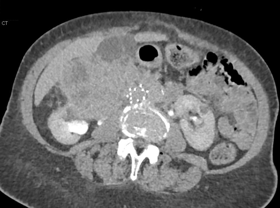 Large Right Papillary Renal Cell Carcinoma - CTisus CT Scan