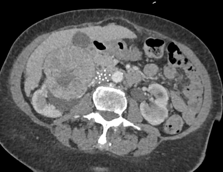 Large Right Papillary Renal Cell Carcinoma - CTisus CT Scan