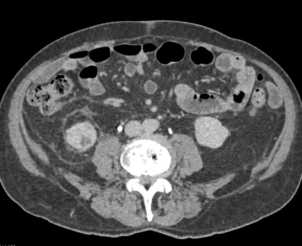 Papillary Renal Cell Carcinoma Lower Pole Right Kidney - CTisus CT Scan