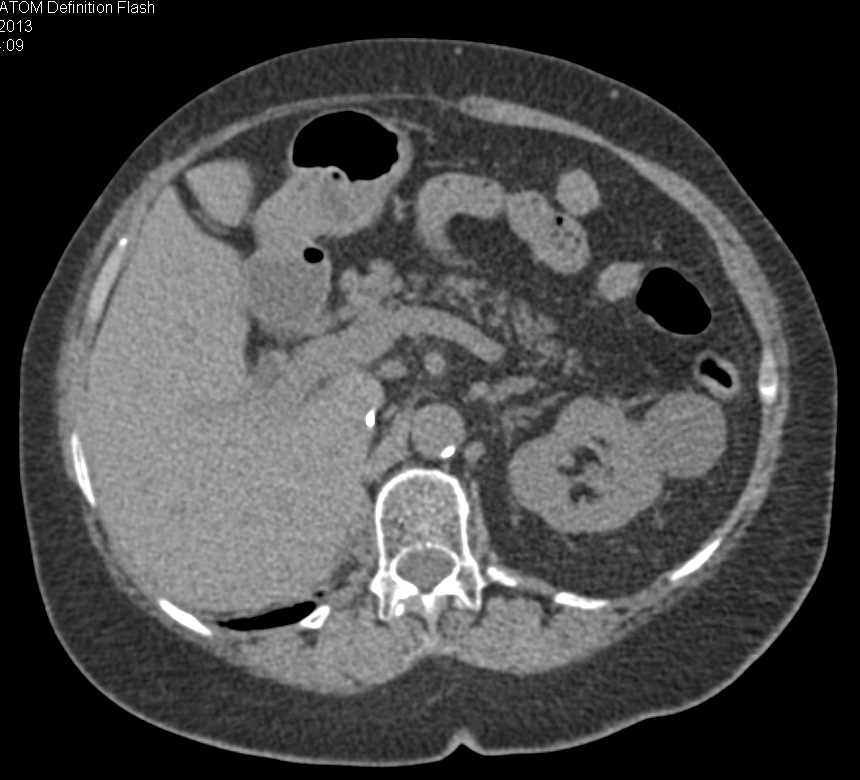 Recurrent Right Renal Cell Carcinoma in Surgical Bed - CTisus CT Scan