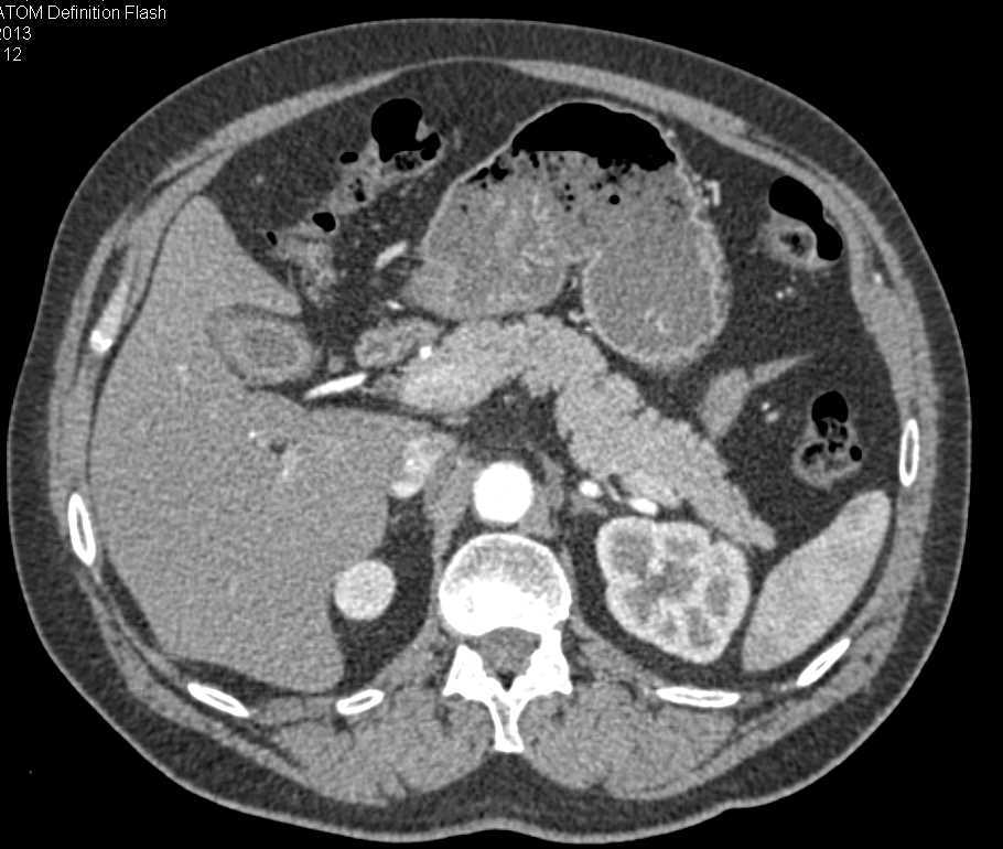 Carcinoma of Distal Left Ureter - CTisus CT Scan