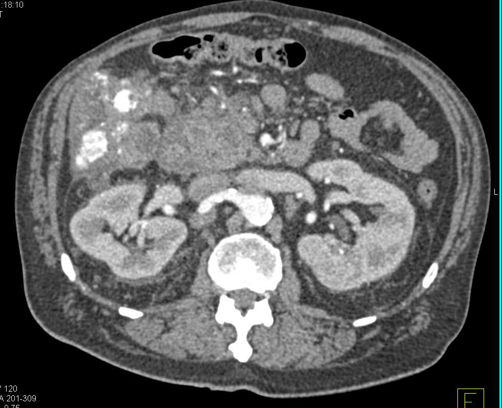 Bilateral Vascular Renal Cell Carcinomas - CTisus CT Scan