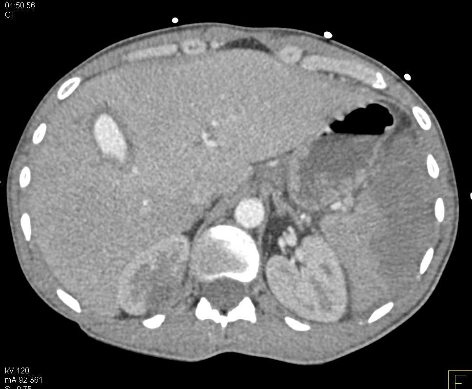 Hepatic Artery Pseudoaneurysm and Splenic Infraction and Renal Infarction in Intravenous Drug Abuse (IVDA) Patient - CTisus CT Scan