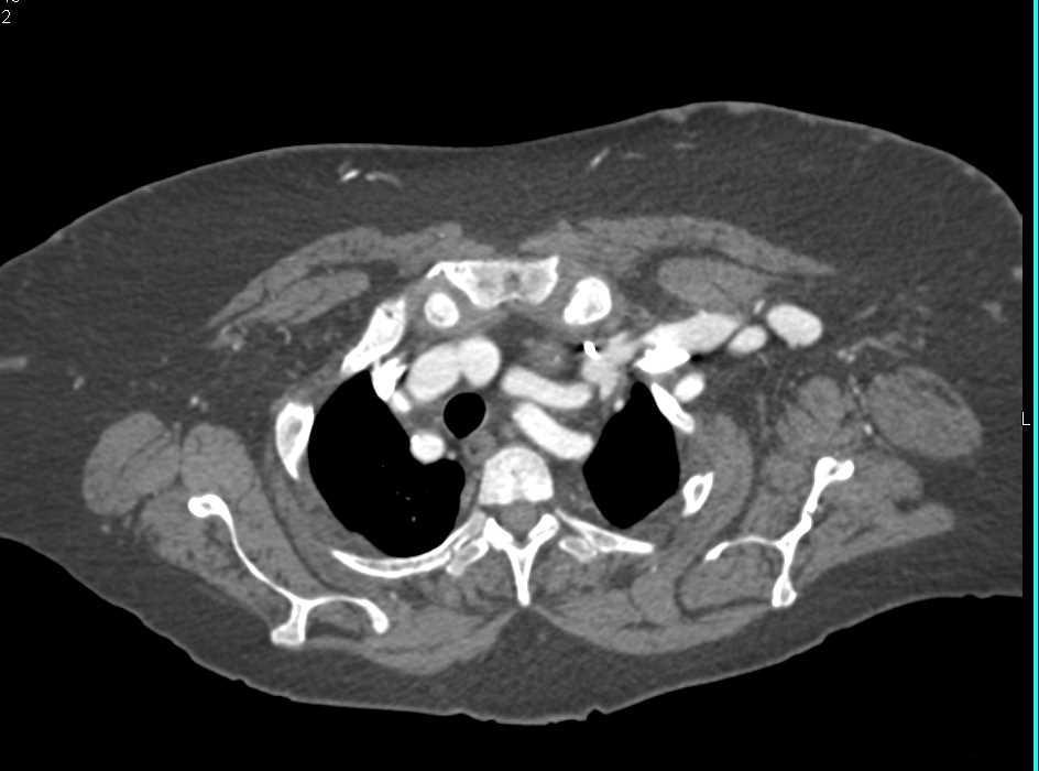 End Stage Renal Disease with Multiple Aneurysms - CTisus CT Scan