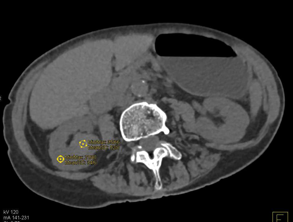 Transitional Cell Carcinoma of the Right Renal Pelvis Looks Like a Renal Cell Carcinoma - CTisus CT Scan