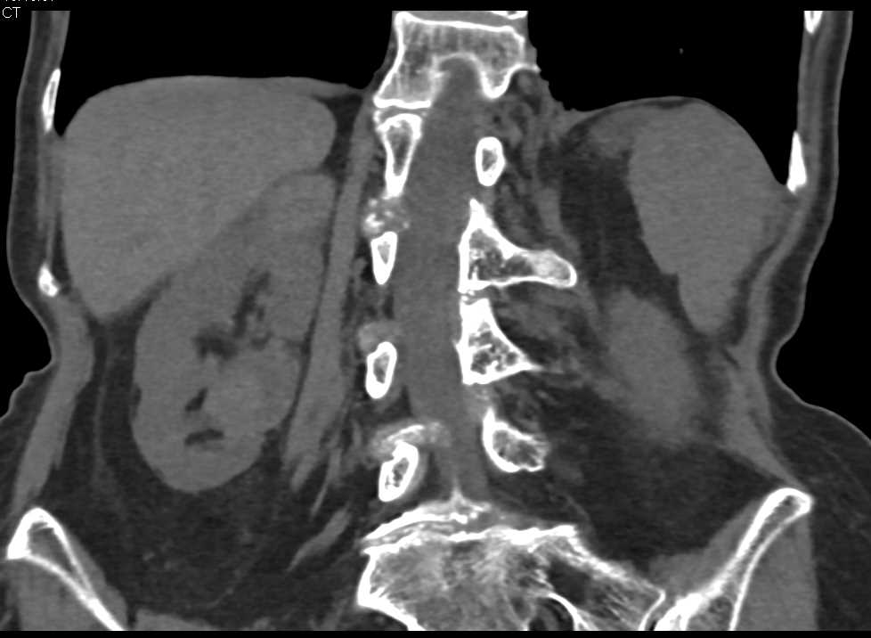 Transitional Cell Carcinoma of the Right Renal Pelvis Looks Like a Renal Cell Carcinoma - CTisus CT Scan