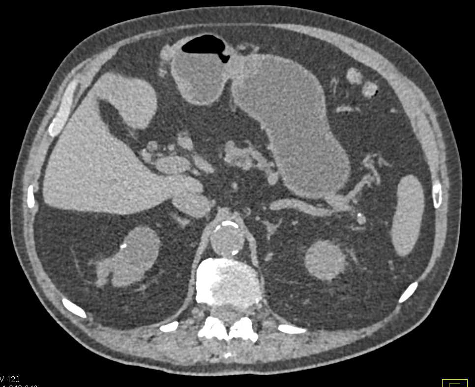 Infiltrating Left Transitional Cell Carcinoma - CTisus CT Scan