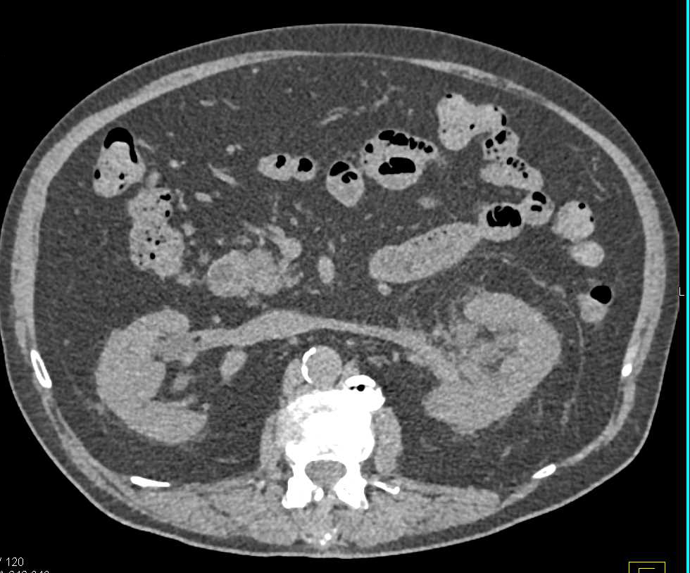 Infiltrating Left Transitional Cell Carcinoma - CTisus CT Scan