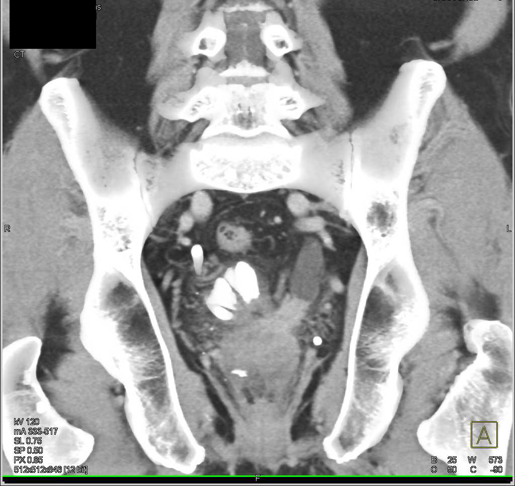 Carcinoma of the Distal Left Ureter - CTisus CT Scan