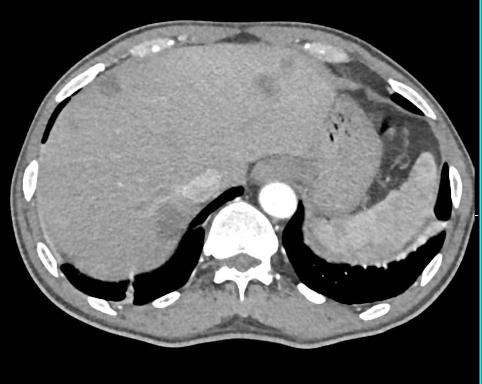 Transitional Cell Carcinoma Right Renal Pelvis and Liver Metastases - CTisus CT Scan