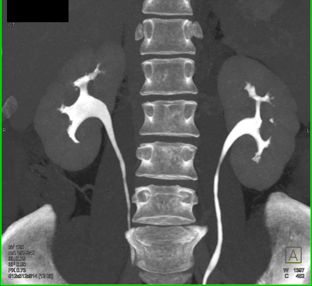 Normal CT Urogram - Kidney Case Studies - CTisus CT Scanning