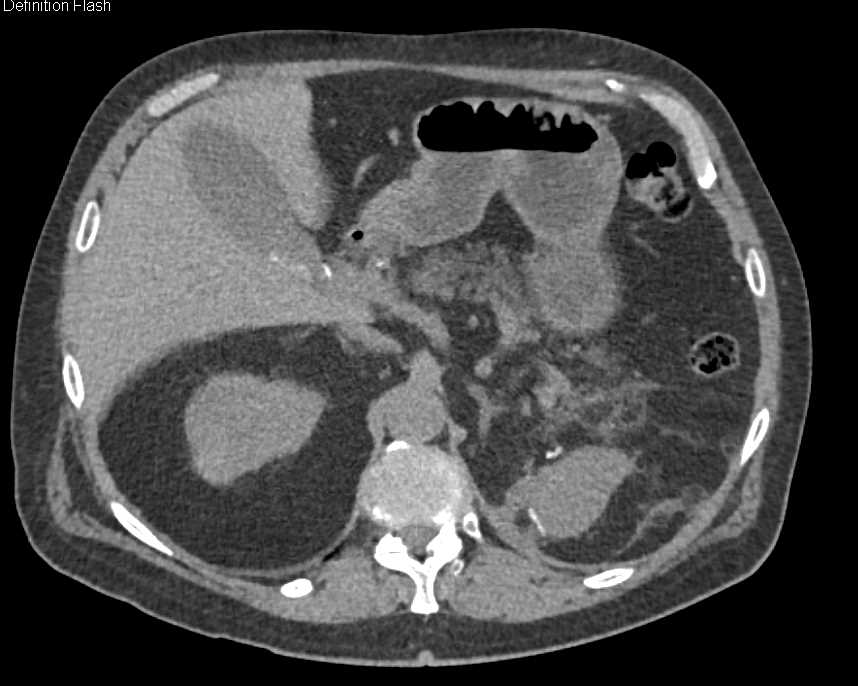 Renal Cell Carcinoma Upper Pole Right Kidney with Arteriovenous (AV) Shunting - CTisus CT Scan