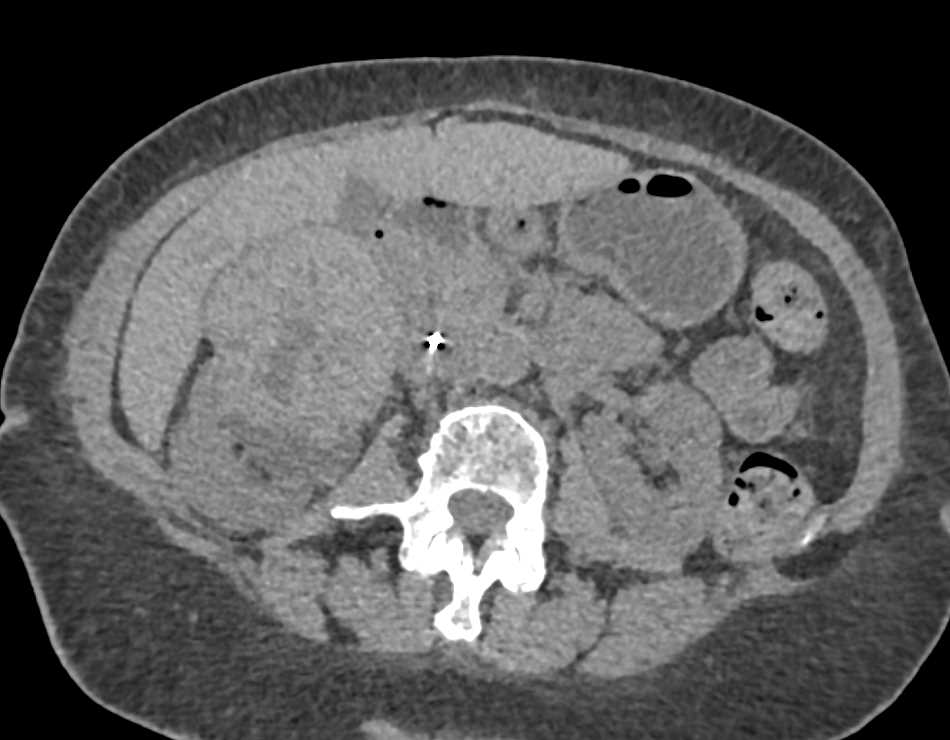 Papillary Right Renal Cell Carcinoma - CTisus CT Scan