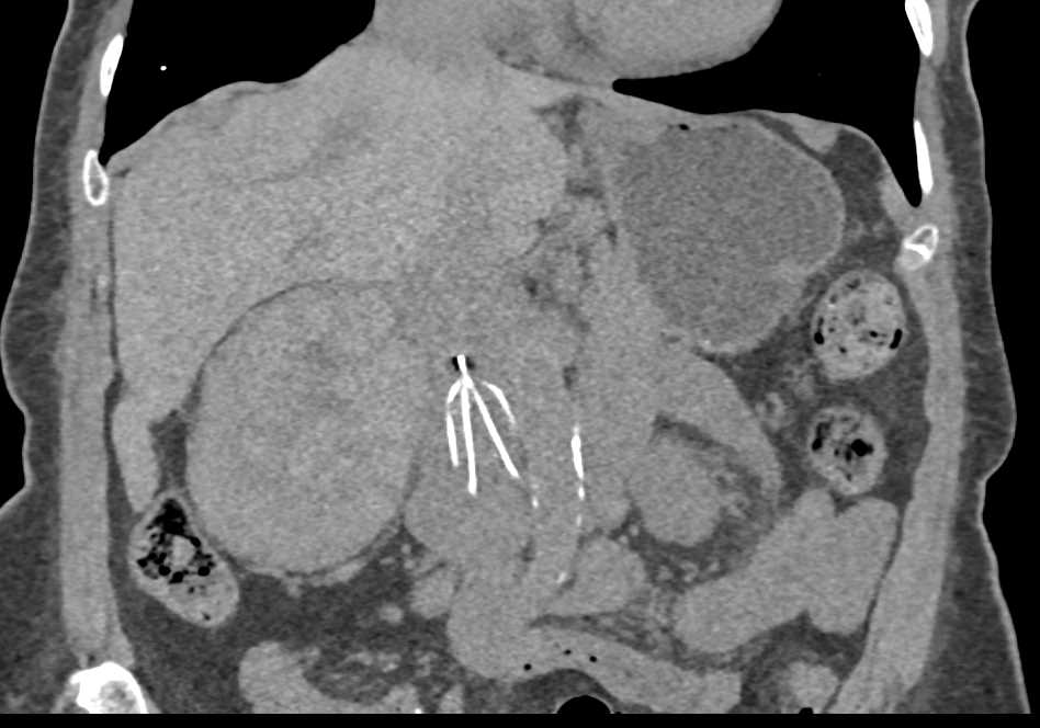 Papillary Right Renal Cell Carcinoma - CTisus CT Scan