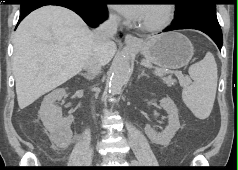 Renal Cell Carcinoma with Neovascularity - CTisus CT Scan