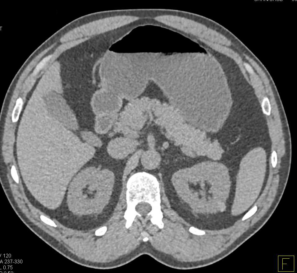 High Density Renal Cysts Left Kidney - CTisus CT Scan