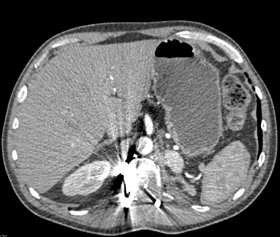 Recurrent Renal Cell Carcinoma in Nephrectomy Bed - CTisus CT Scan