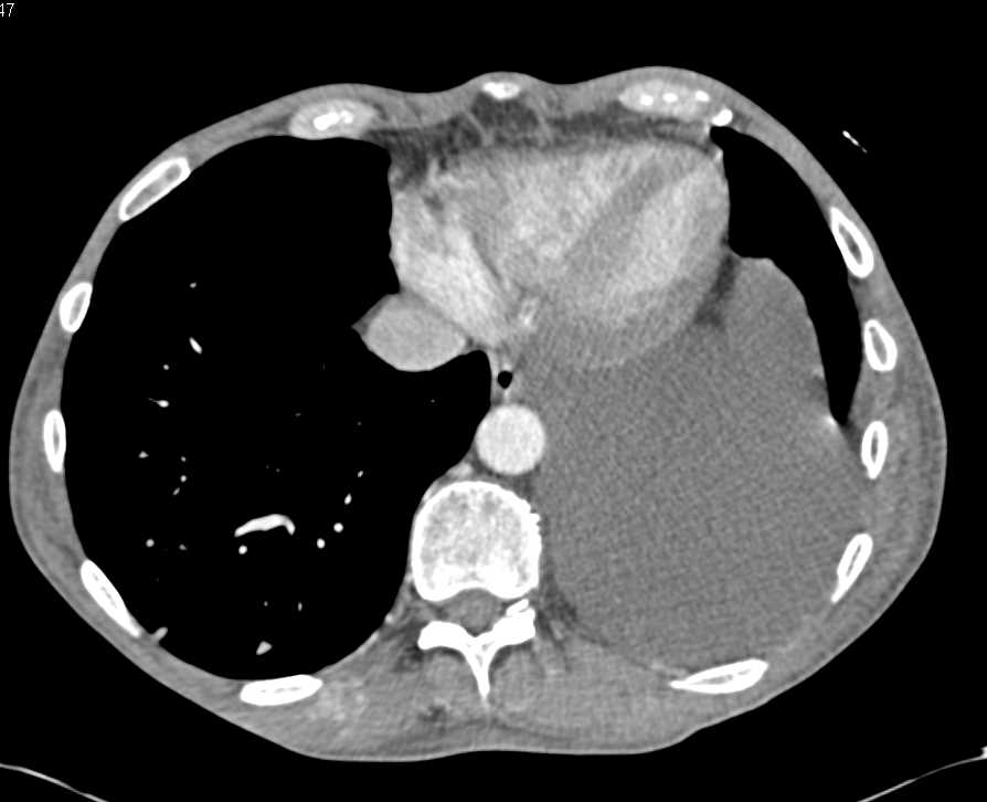 Metastatic Renal Cell Carcinoma to the Pleura and Muscle - CTisus CT Scan