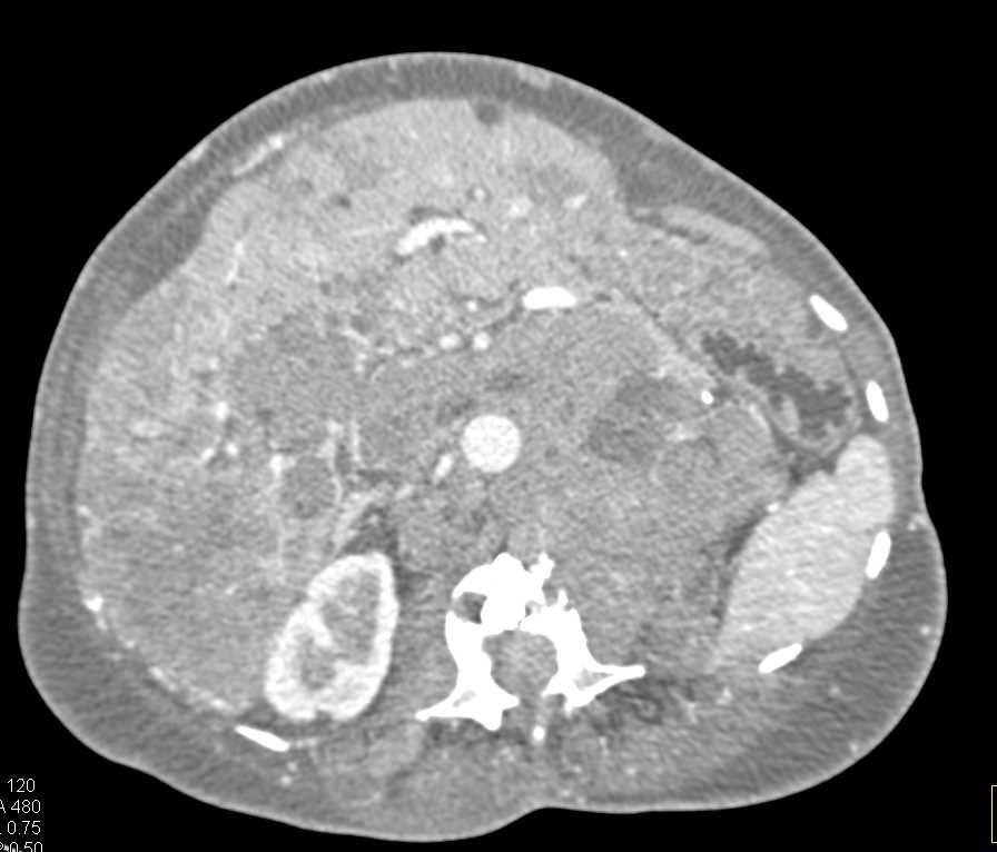 Recurrent Renal Cell Carcinoma in Nephrectomy Bed as well as Liver and Bone - CTisus CT Scan