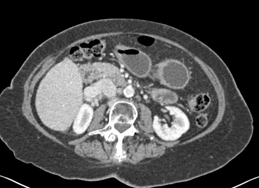 Renal Cell Carcinoma with Neovascularity - CTisus CT Scan
