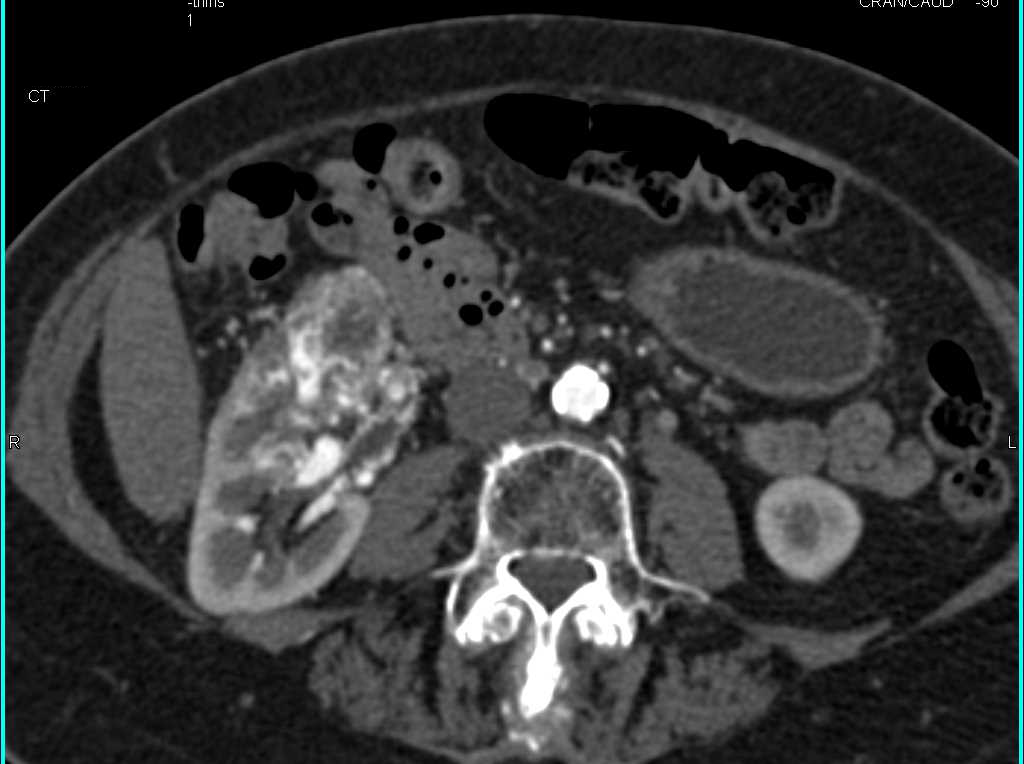Renal Cell Carcinoma with Neovascularity - CTisus CT Scan