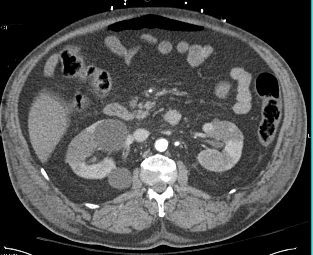 Bilateral Renal Infarcts - CTisus CT Scan