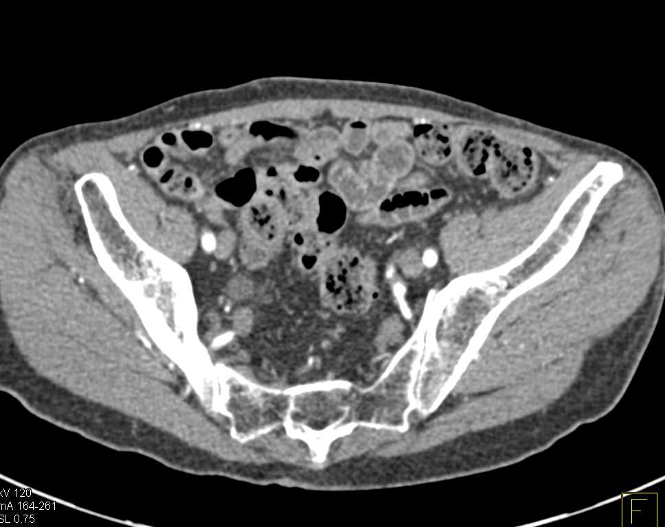 Right Hydronephrosis and Hydroureter due to Infiltrative Transitional Cell Cancer (TCC) of the Bladder - CTisus CT Scan